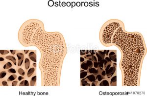 Osteoporosis - Dr. Dan Malone - Beaver Dam and Madison WI