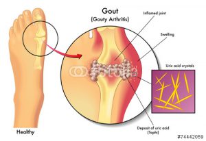 gout examples - Dr. Daniel G. Malone in Madison WI